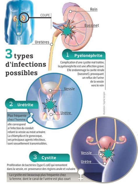 sodomie infection urinaire|La sodomie et les risques d’infection urinaire